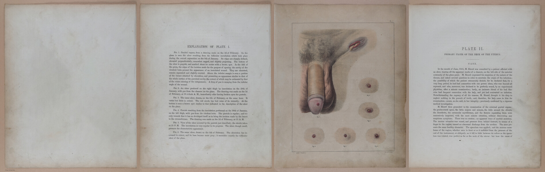 E345 - Illustrations of Syphilitic - i11859-11860-11861
